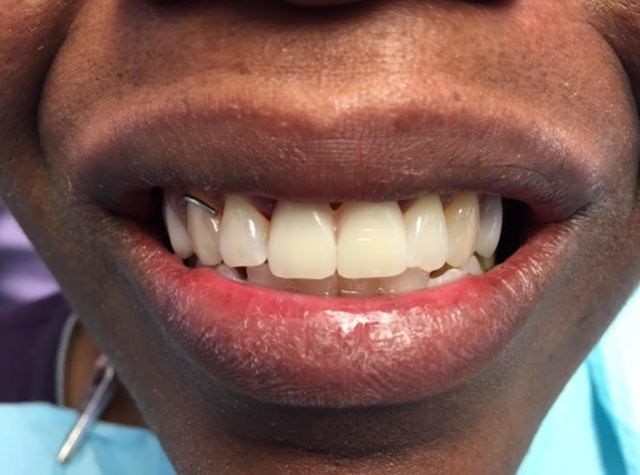 Young Man With Dentures Lapel IN 46051